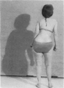 Preoperative posterior standing view of patient. Note marked sciatic spinal deformity with right lumbosacral list