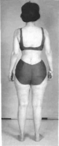 FIG. 3. Postoperative standing posterior view of patient showing erect posture with disappearance of lumbosacral list.