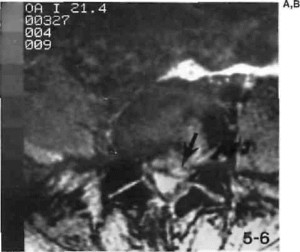 Sciatic Spinal Deformity in MRI