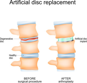 Diagram of an artificial disc replacement within the spine