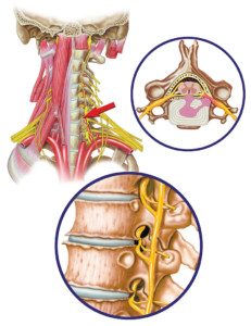 Cervical spine disc hernia